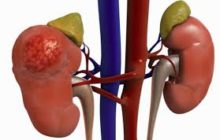 What is Chronic Kidney Disease?