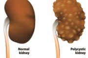 What is Polycystic Kidney Disease?