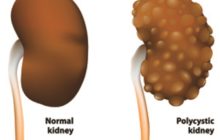 What is Polycystic Kidney Disease?