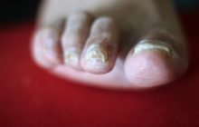 Why do we get fungal nail infections and how can we treat them?