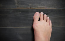 What is a bunion and do I need to get mine treated?