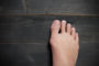 What is a bunion and do I need to get mine treated?